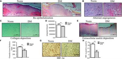 Insulin-Containing Wound Dressing Promotes Diabetic Wound Healing Through Stabilizing HIF-1α